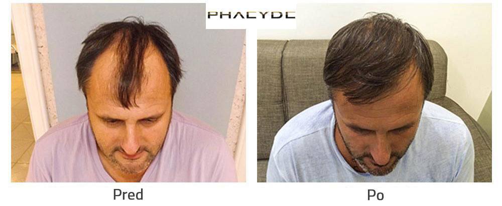 transplantácia vlasov pred a po