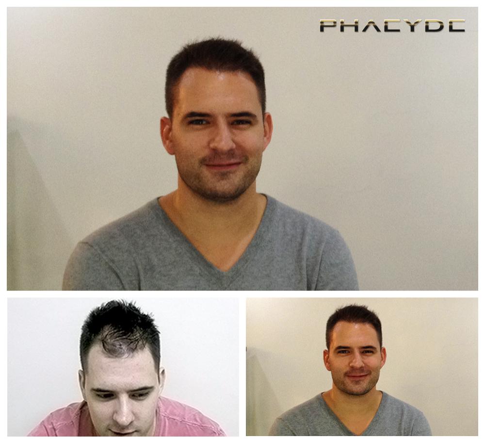 Haartransplantation fue ergebnisse vorher nachher bilder andras somogyi - PHAEYDE Unsere Klinik