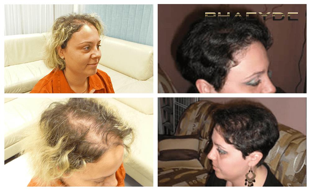 Haartransplantation fue ergebnisse vorher nachher bilder christina torok woman - PHAEYDE Unsere Klinik
