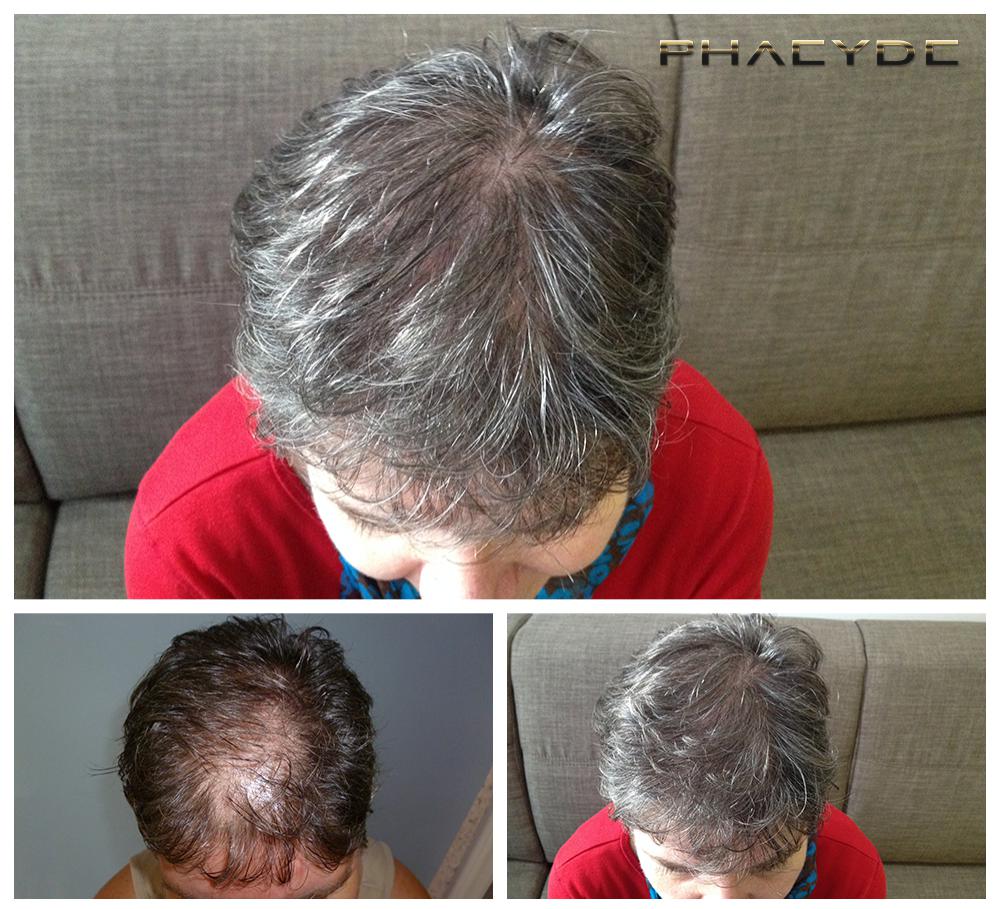 Haartransplantation fue ergebnisse vorher nachher bilder erika d - PHAEYDE Unsere Klinik