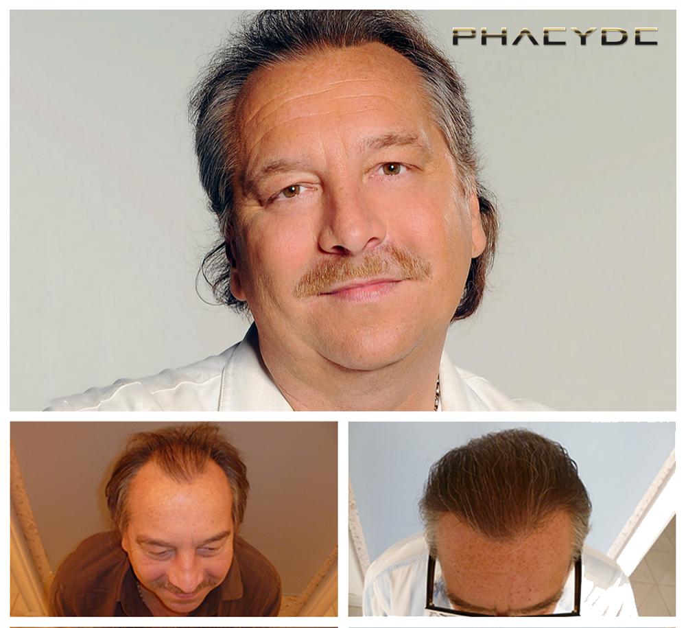 Haartransplantation fue ergebnisse vorher nachher bilder imre bajor - PHAEYDE Unsere Klinik