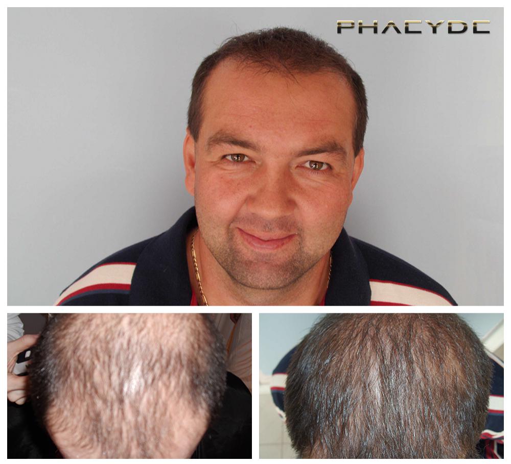 Haartransplantation fue ergebnisse vorher nachher bilder laszlo d - PHAEYDE Unsere Klinik