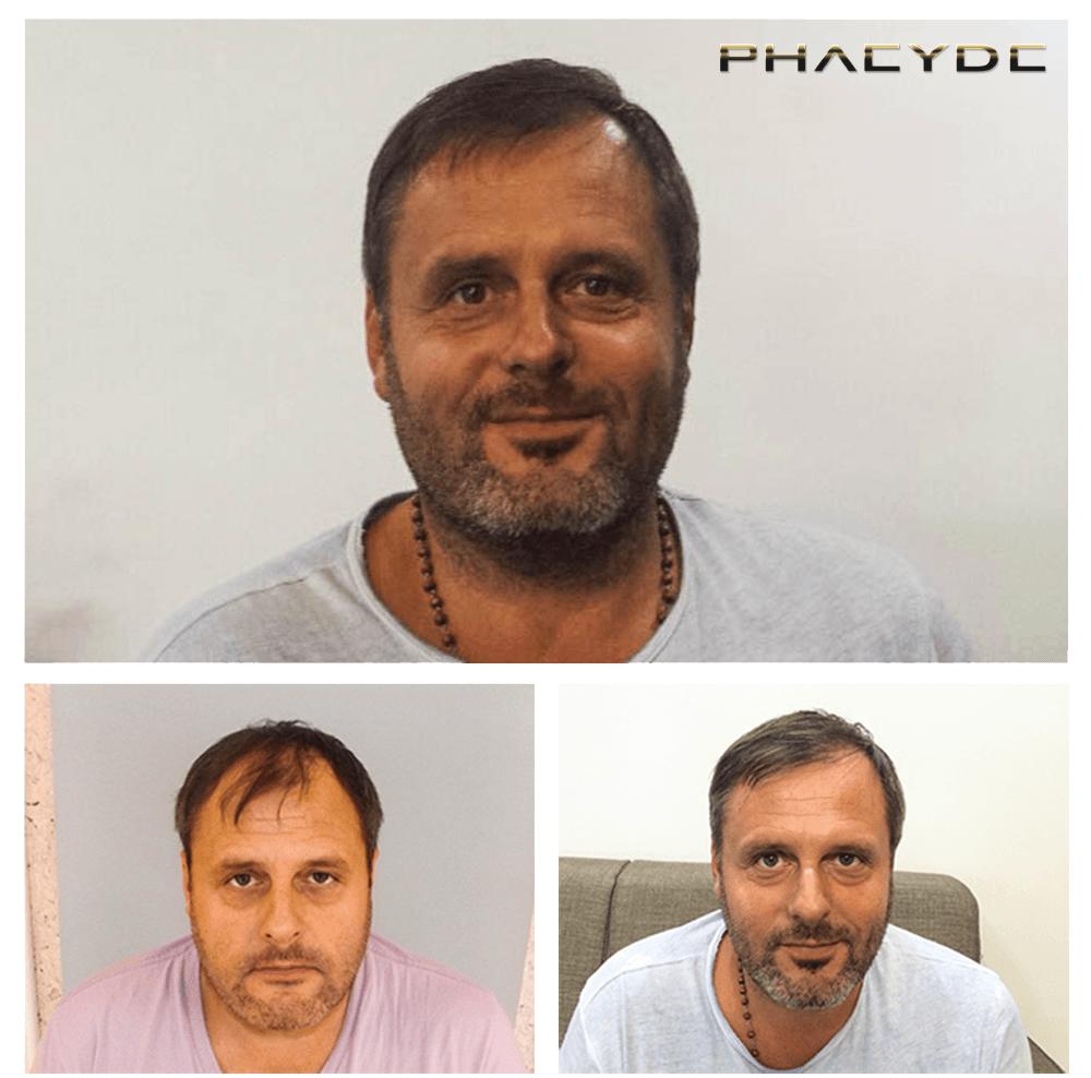Haartransplantation fue ergebnisse vorher nachher bilder michael k - PHAEYDE Unsere Klinik