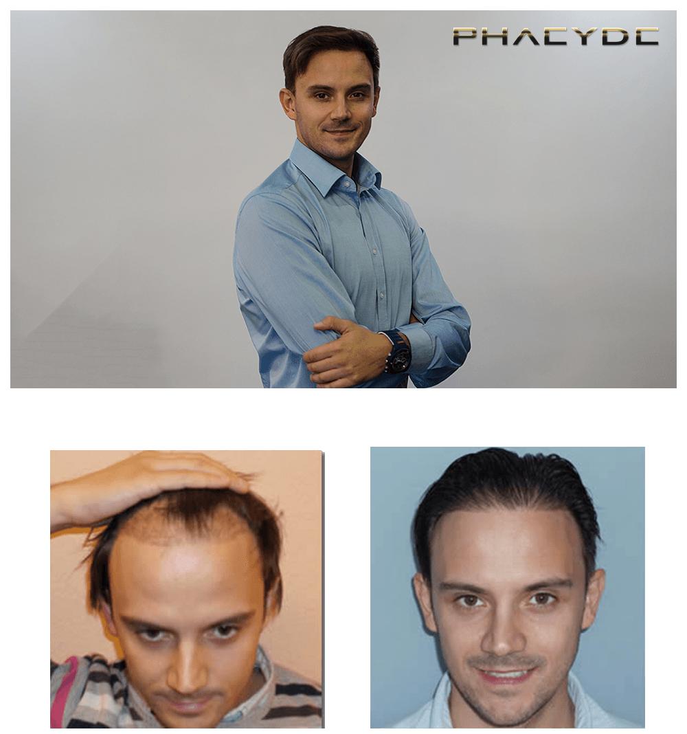 Haartransplantation fue ergebnisse vorher nachher bilder michael soos - PHAEYDE Unsere Klinik