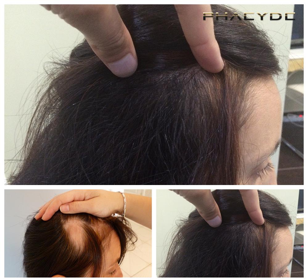 Haartransplantation fue ergebnisse vorher nachher bilder reka d - PHAEYDE Unsere Klinik