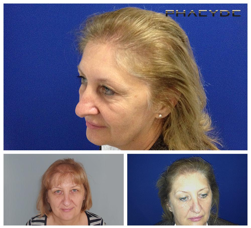 Haartransplantation fue ergebnisse vorher nachher bilder susanne mikola - PHAEYDE Unsere Klinik