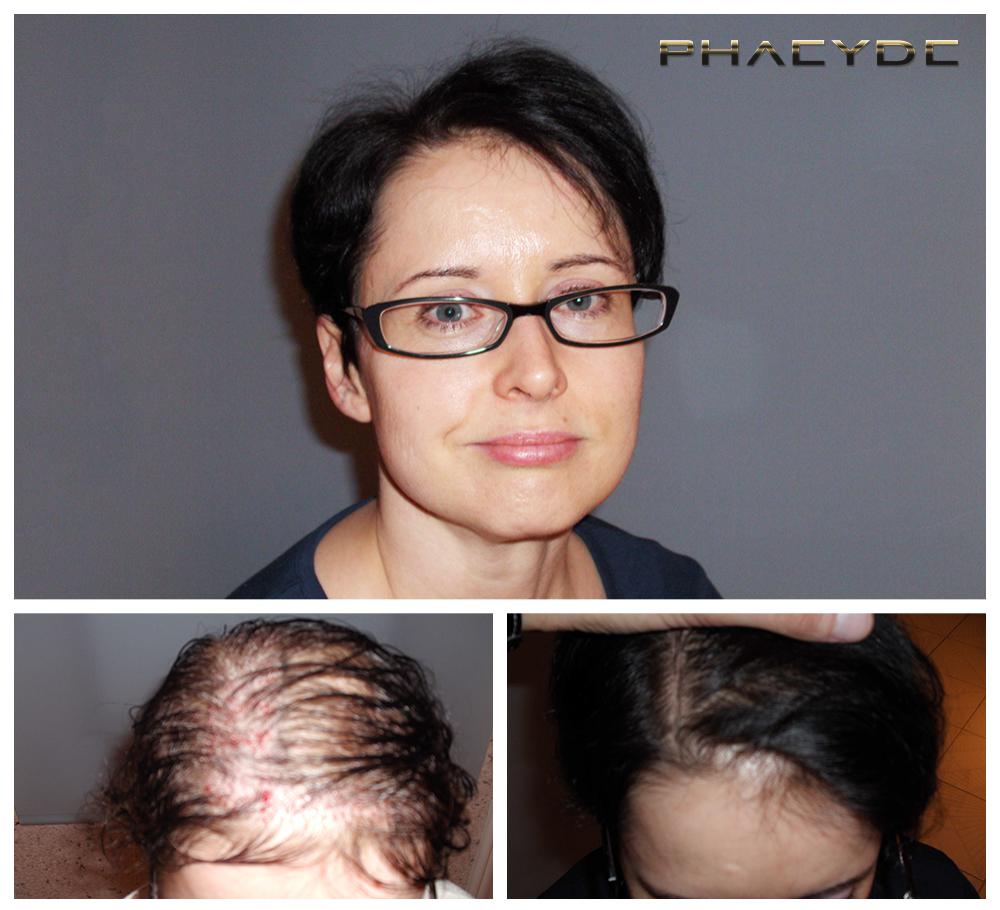 Haartransplantation fue ergebnisse vorher nachher bilder susanne ujhegyi woman - PHAEYDE Unsere Klinik