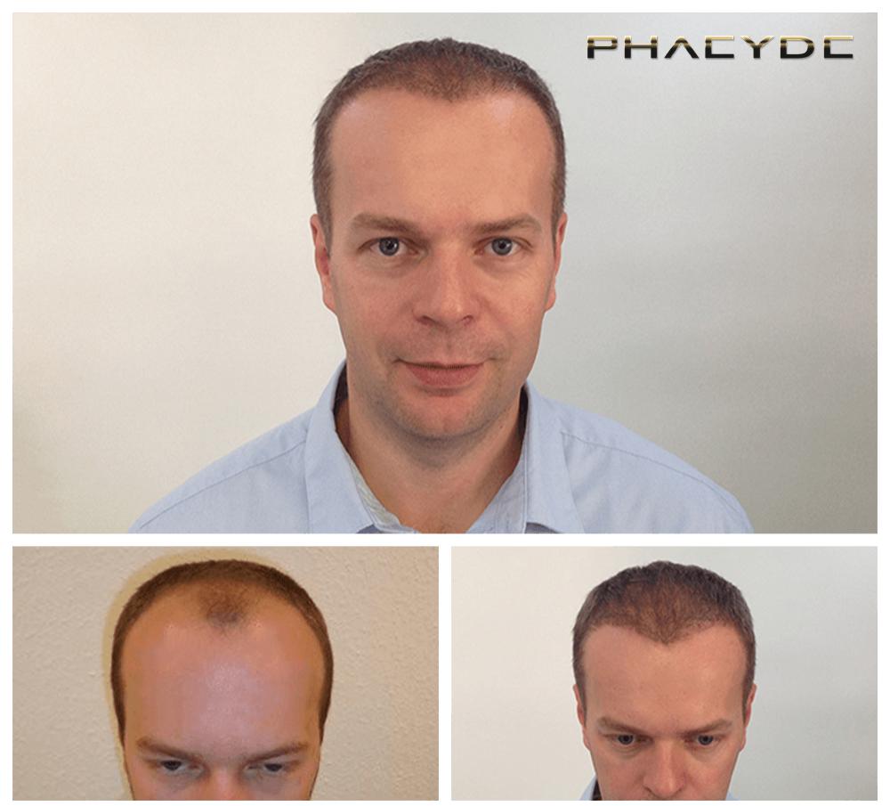 Haartransplantation fue ergebnisse vorher nachher bilder thomas lajtos - PHAEYDE Unsere Klinik
