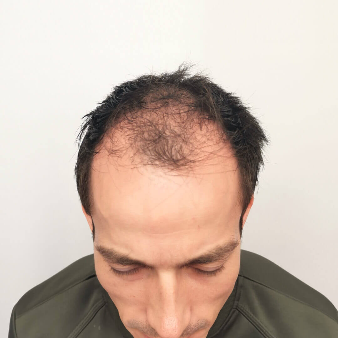 Which Hair Transplant Method is the Best in 2025