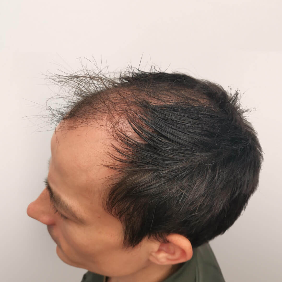 Which Hair Transplant Method is the Best in 2025