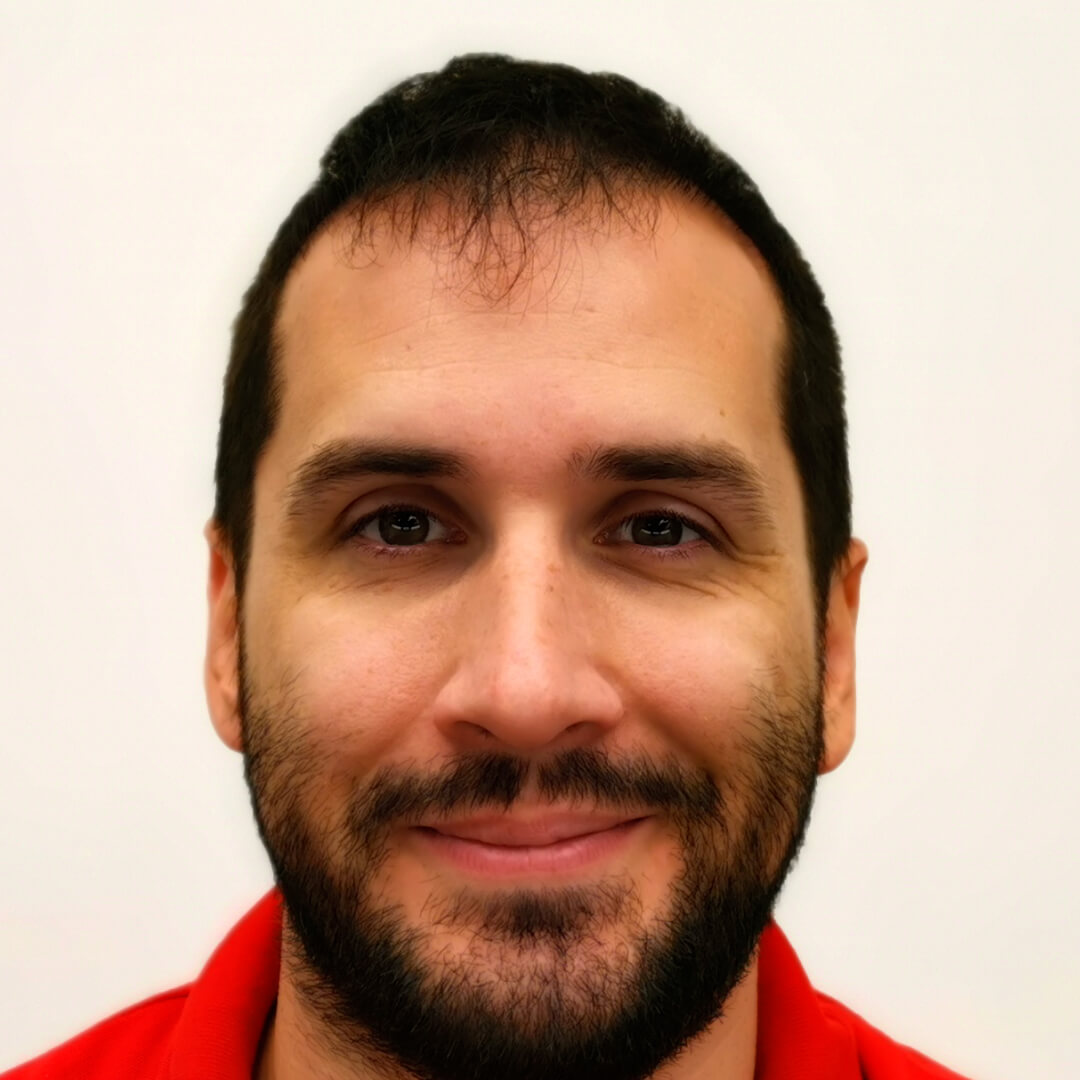 Hair transplant before-after: Norbert - PHAEYDE Clinic