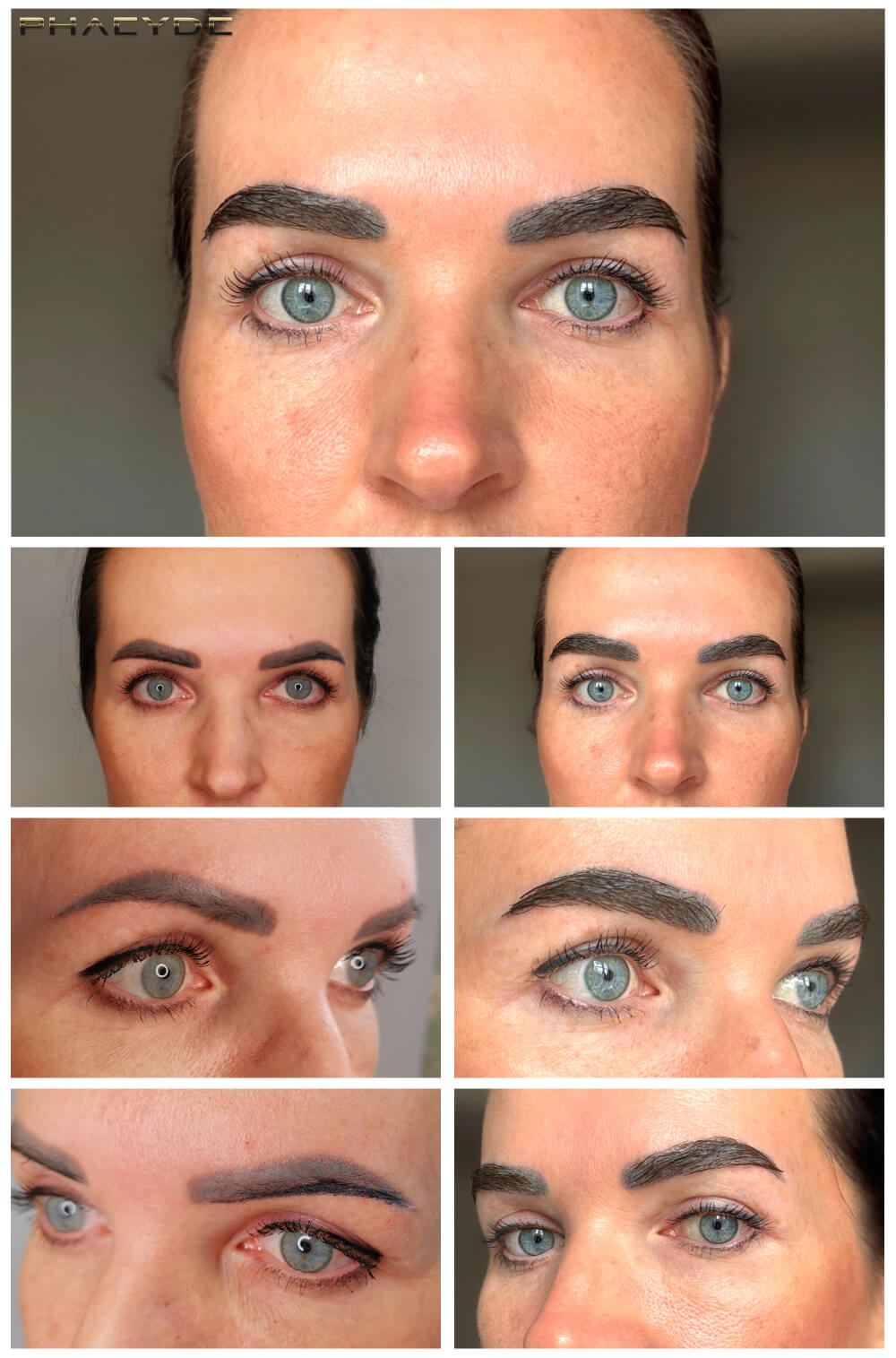 Eyebrow Transplantation