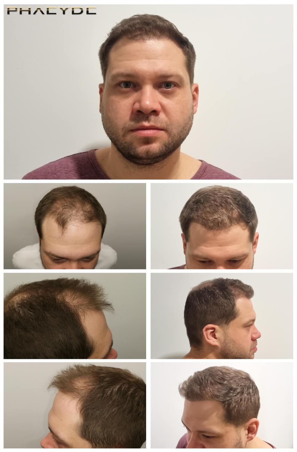 Hair Transplant Turkey | Save 70% on UK Prices | All-Inclusive Package
