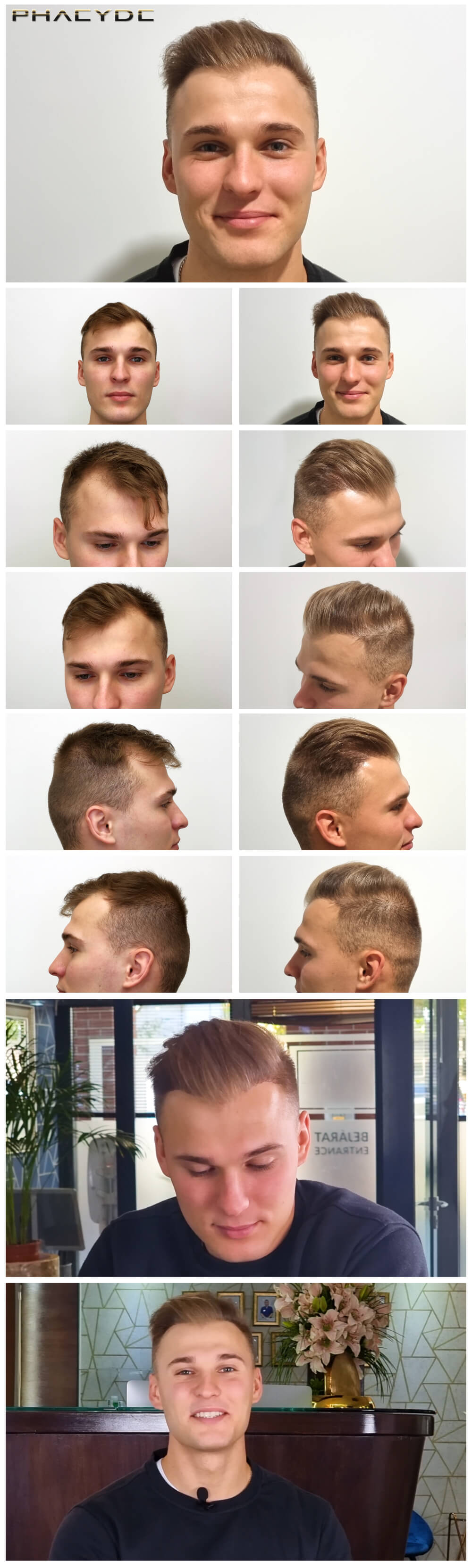 Hair Transplantation and Hair Pigmentation Before After Photos - Results