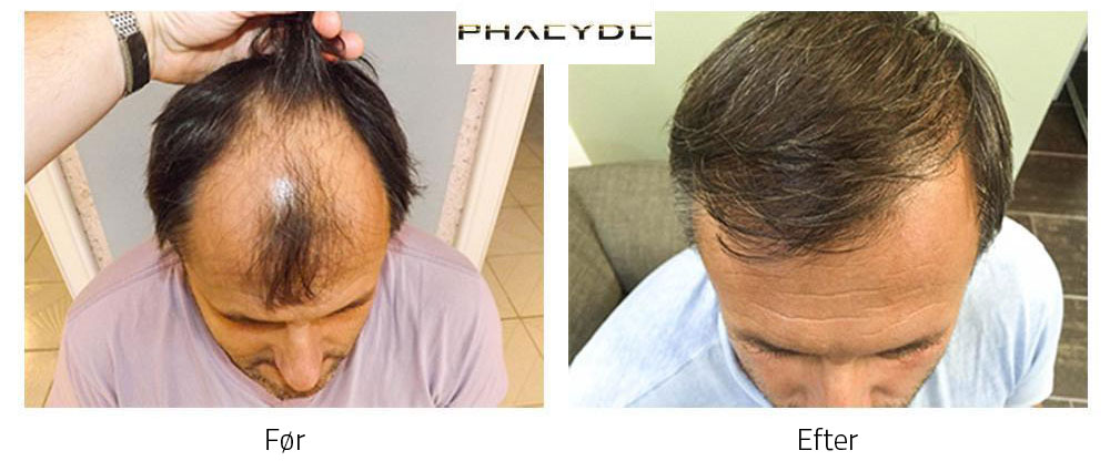 Resultatet af en hårtransplantation 