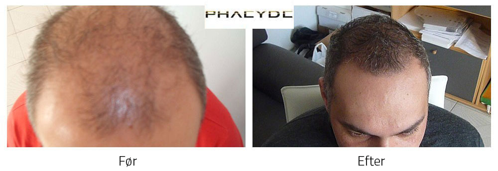 Resultatet af en hårtransplantation 
