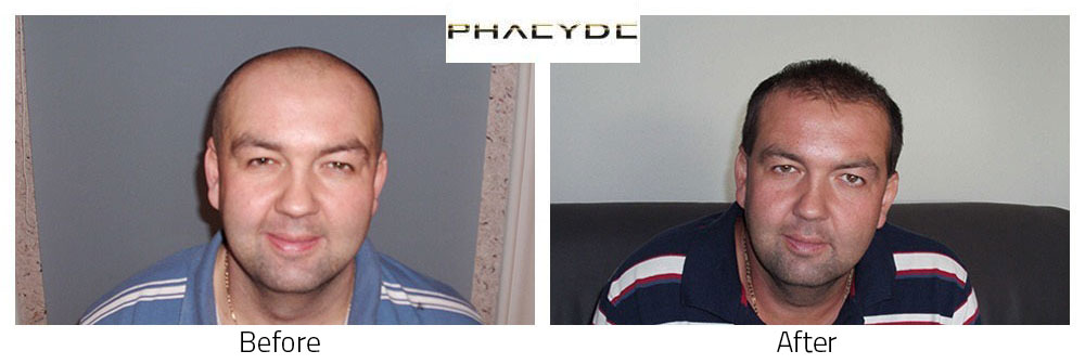 Hair transplant D. Laszlo 8000+ before after