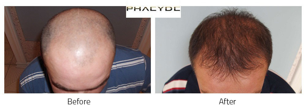 Hair transplant D. Laszlo 8000+ before after
