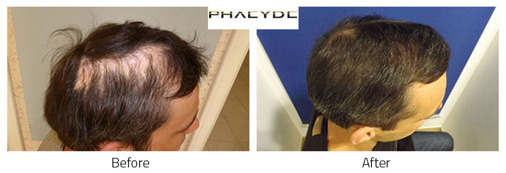 Hair transplant P. Peter 5000 before after