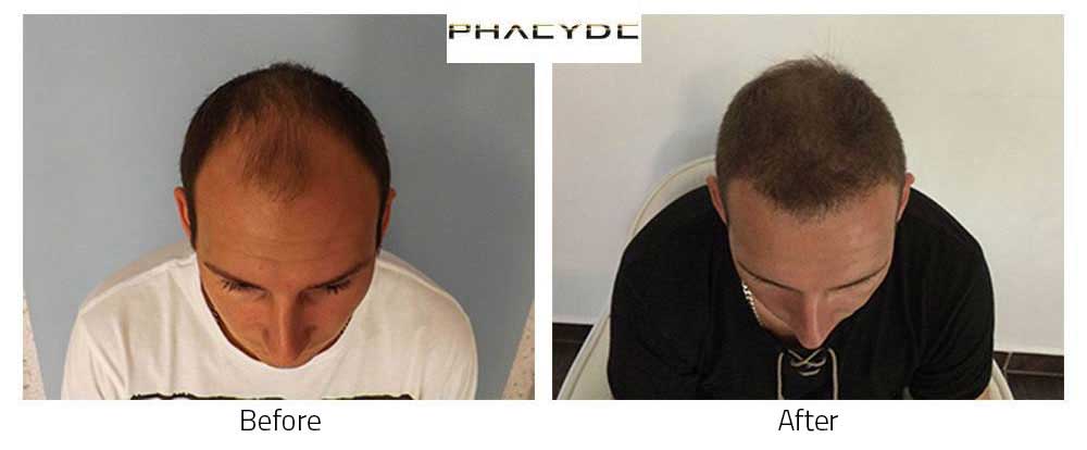 Hair Transplant Before After Result Photos