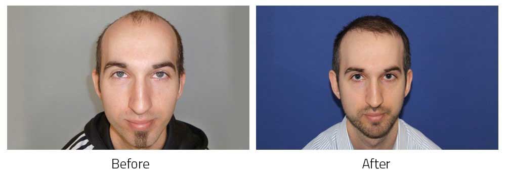 Hair Transplant Before After Result Photos