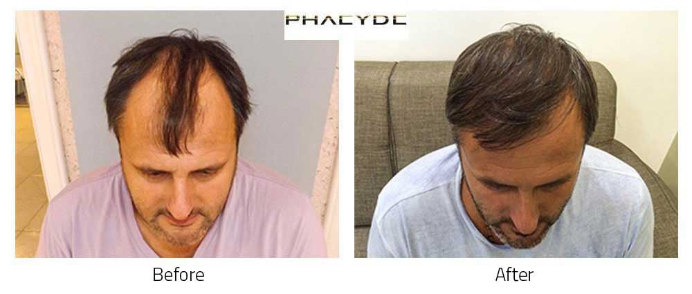 Hair transplant before after result