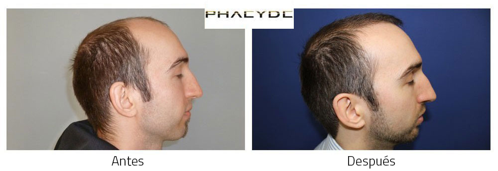 Trasplante de pelo Antes - Después Resultado