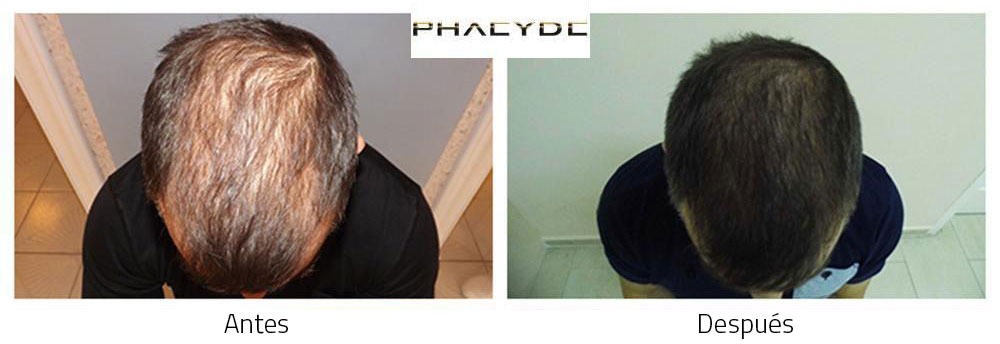 Trasplante de pelo Antes - Después Resultado