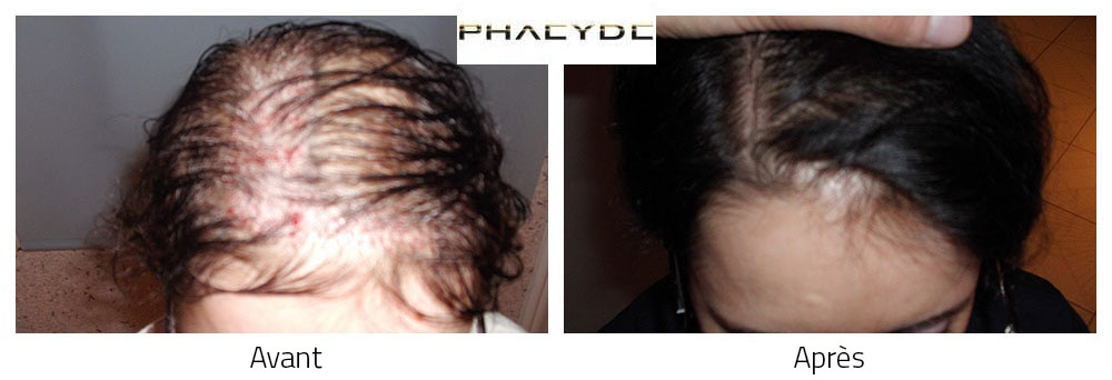 Greffe de cheveux avant et après résultat