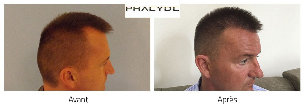 Greffe de cheveux avant et après résultat