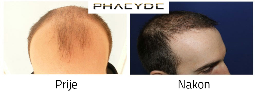 Transplantacija kose prije poslije rezultata