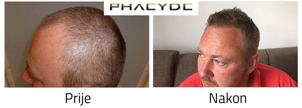Transplantacija kose prije poslije rezultata