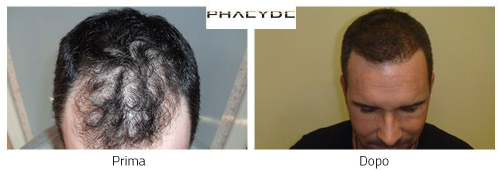 Trapianto di capelli prima e dopo risultati