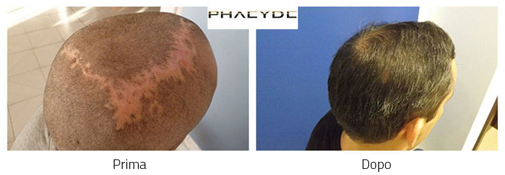 Trapianto di capelli prima e dopo risultati