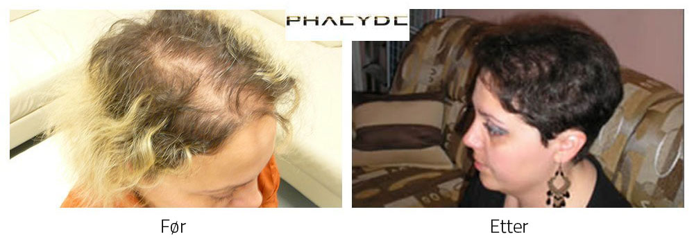 Hårtransplantasjon før - etter resultat