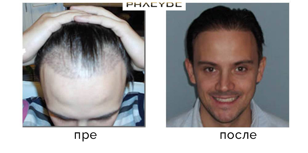 Transplantacija kose pre nakon