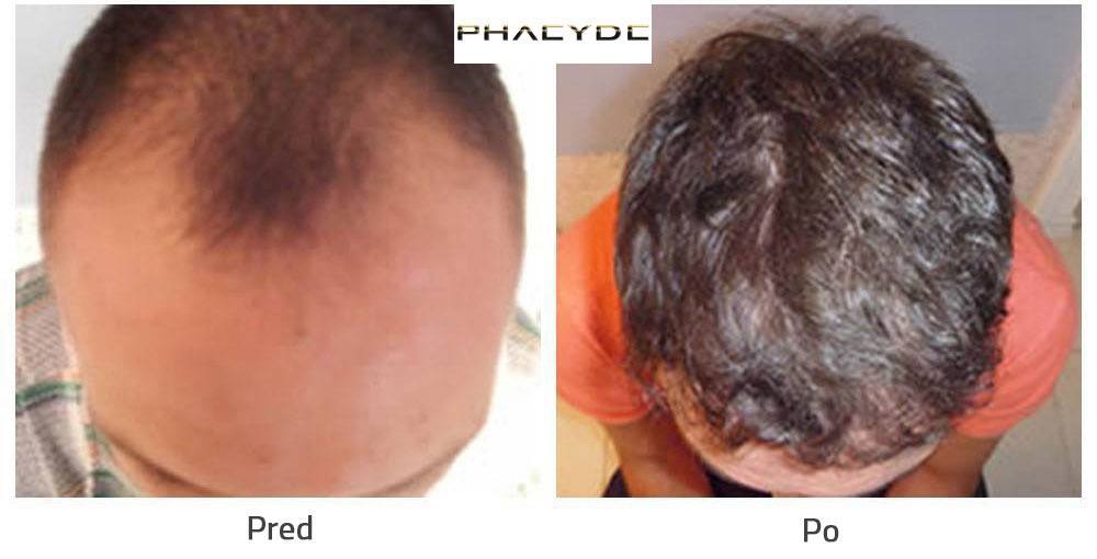 Transplantácia vlasov alebo Nastrelovanie Vlasov pred po následok