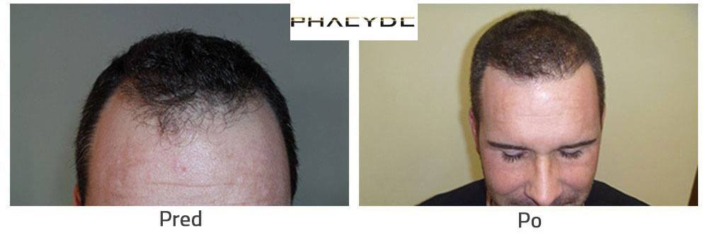Transplantácia vlasov alebo Nastrelovanie Vlasov pred po následok