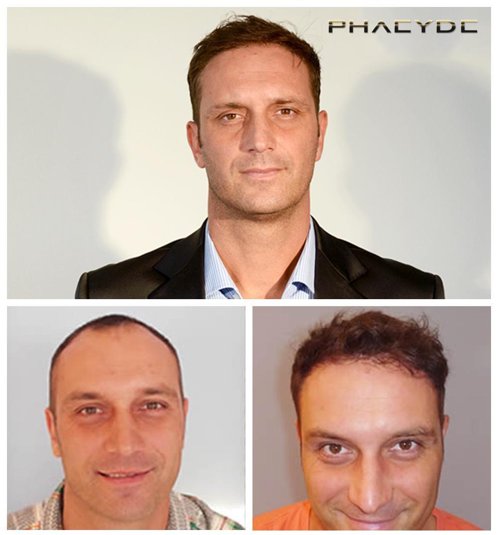 Hair transplant fue results before after photos istvan szebeni - PHAEYDE Clinic