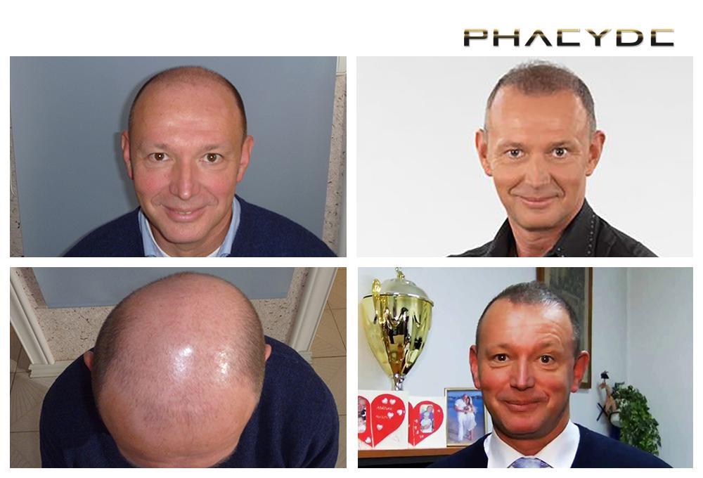 Hair transplant fue results before after photos pal gyorfi - PHAEYDE Clinic