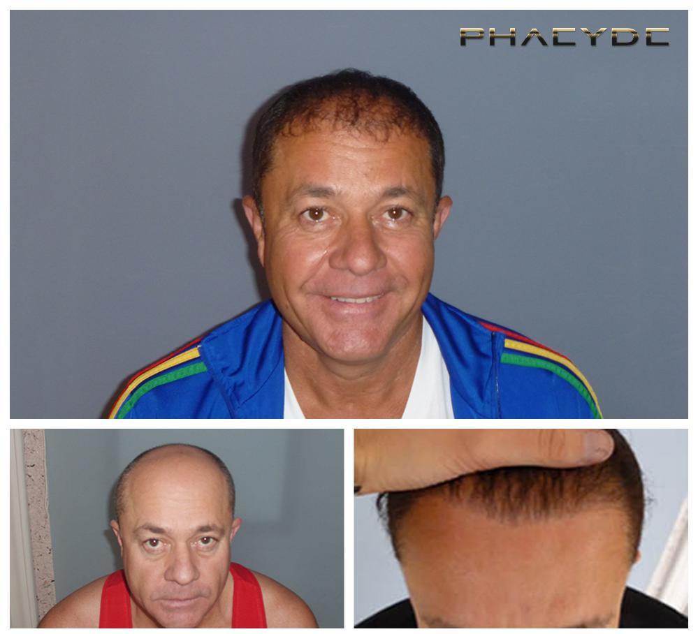 Hair transplant fue results before after photos zoltan cs - PHAEYDE Clinic