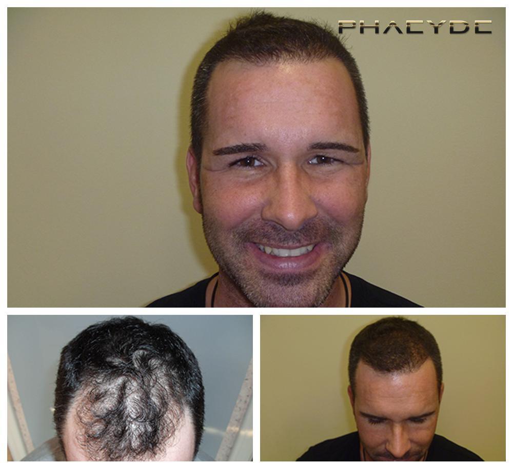 Hair Transplantation and Hair Pigmentation Before After Photos - Results